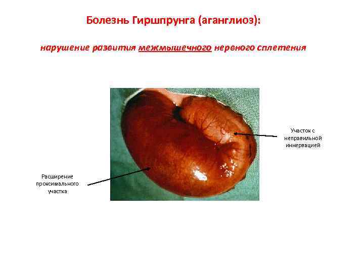 Болезнь Гиршпрунга (аганглиоз): нарушение развития межмышечного нервного сплетения Участок с неправильной иннервацией Расширение проксимального