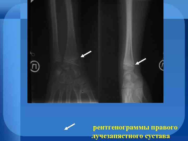 рентгенограммы правого лучезапястного сустава 