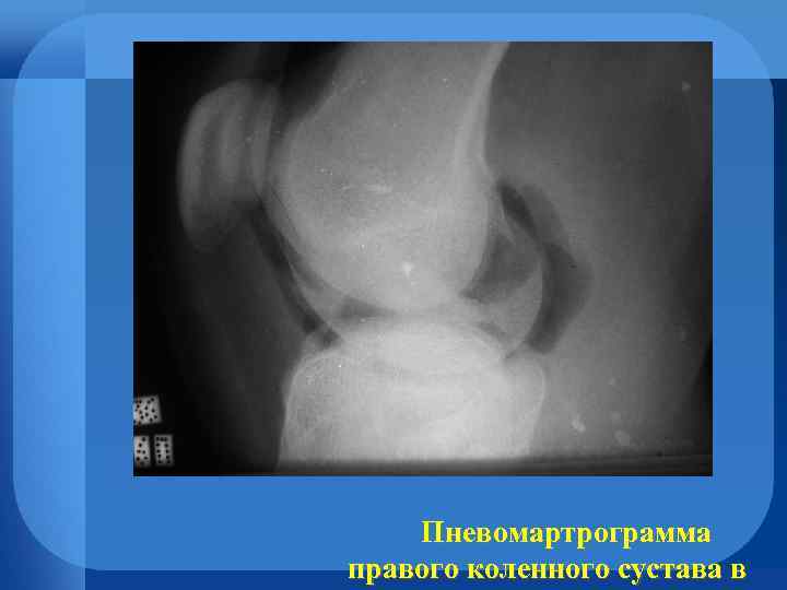 Пневомартрограмма правого коленного сустава в 