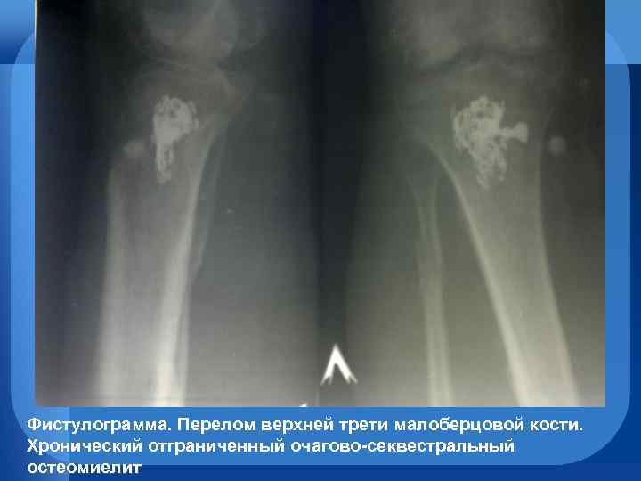 Фистулограмма. Перелом верхней трети малоберцовой кости. Хронический отграниченный очагово-секвестральный остеомиелит 