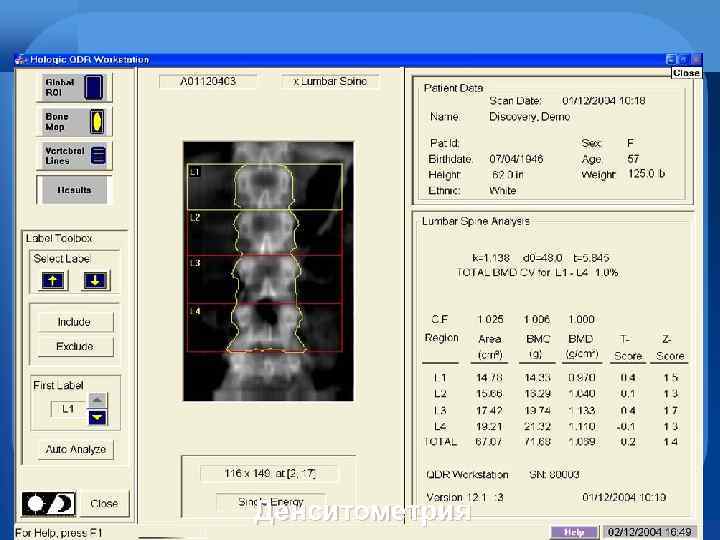 Денситометрия 