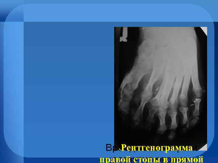 Рентгенограмма Врожденные пороки правой стопы в прямой развития опорно- 