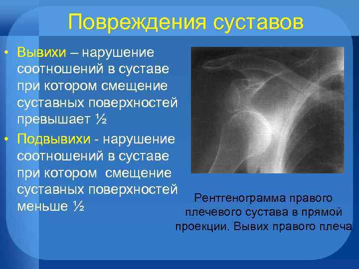 Повреждения суставов • Вывихи – нарушение соотношений в суставе при котором смещение суставных поверхностей
