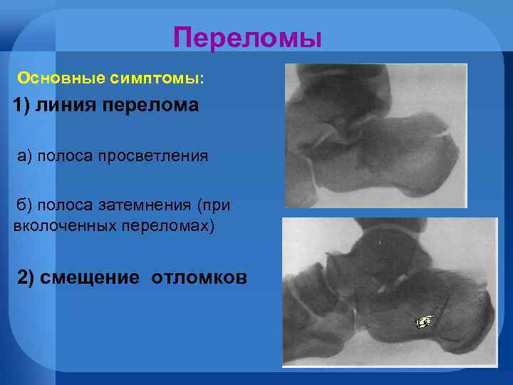 Переломы Основные симптомы: 1) линия перелома а) полоса просветления б) полоса затемнения (при вколоченных