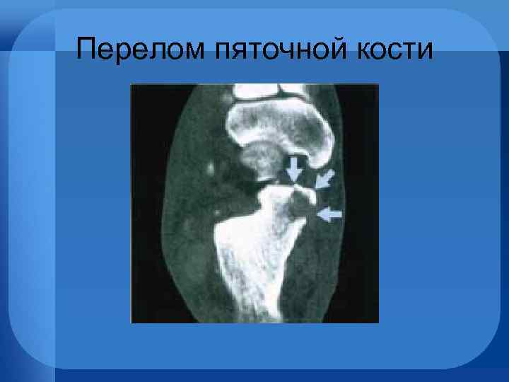 Перелом пяточной кости 