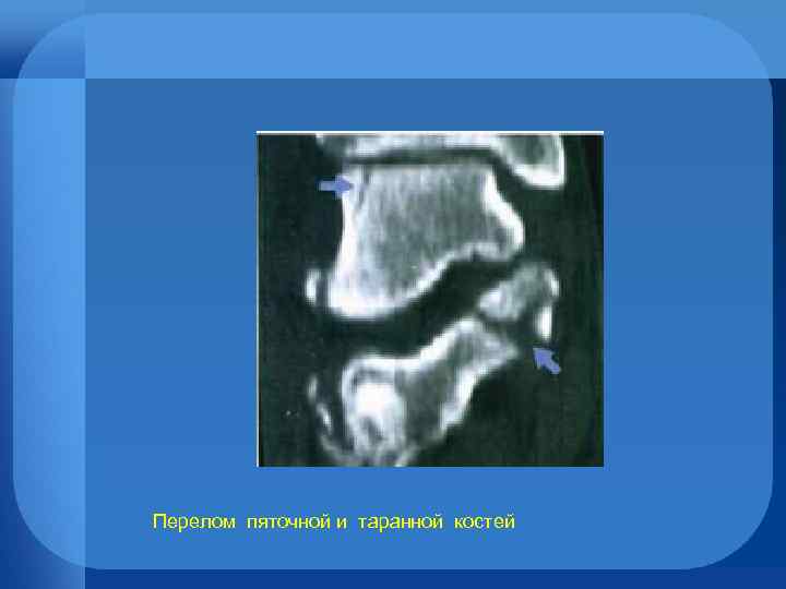 Перелом пяточной и таранной костей 