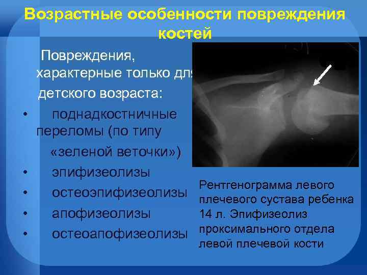 Эпифизеолиз это. Эпифизеолиз плечевой кости. Перелом эпифизеолиз плечевой кости. Эпифизеолиз плечевой кости дистальный. Апофезеолис плечевой кости.