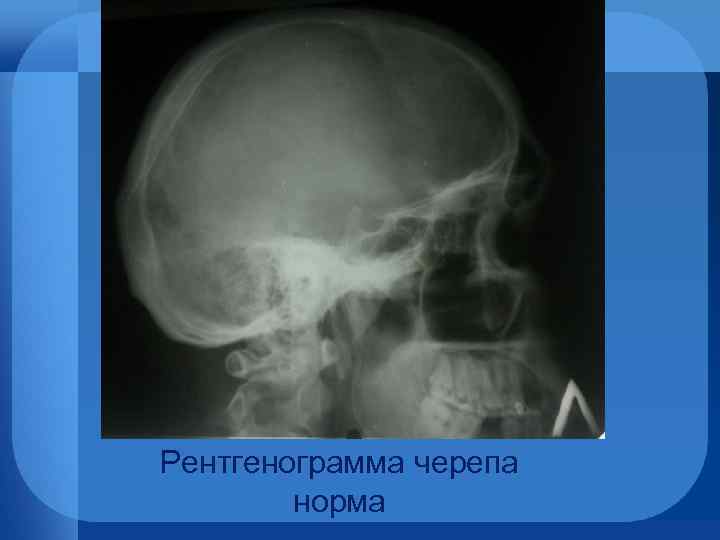 Рентгенограмма черепа норма 