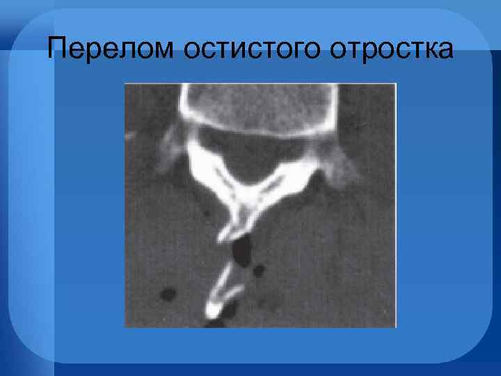Перелом остистого отростка 