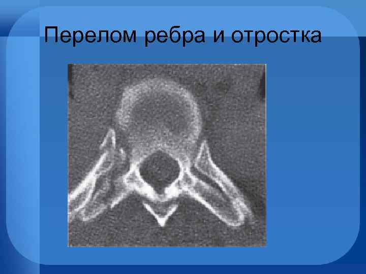 Перелом ребра и отростка 