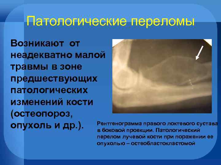Патологические переломы Возникают от неадекватно малой травмы в зоне предшествующих патологических изменений кости (остеопороз,