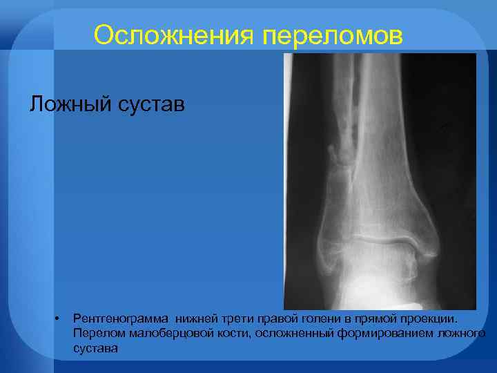 Осложнения переломов. Ложный сустав малоберцовой кости. Осложнения перелома малоберцовой кости. Формирование ложного сустава. Ложный сустав на рентгенограмме.