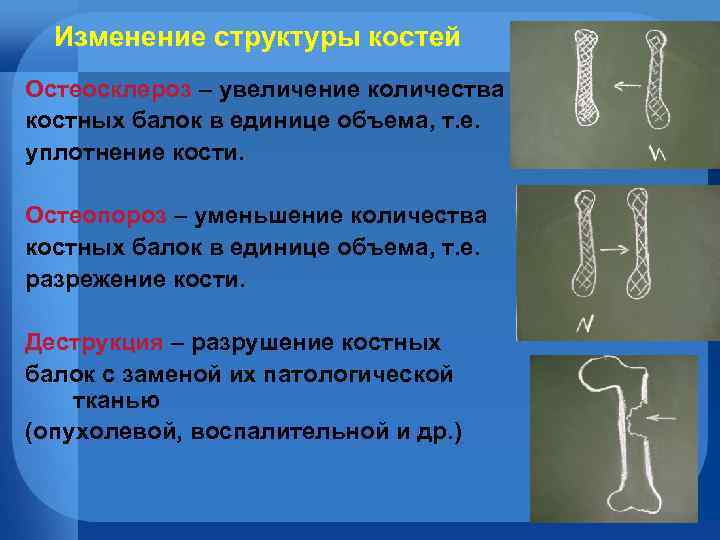 Изменение структуры костей Остеосклероз – увеличение количества костных балок в единице объема, т. е.