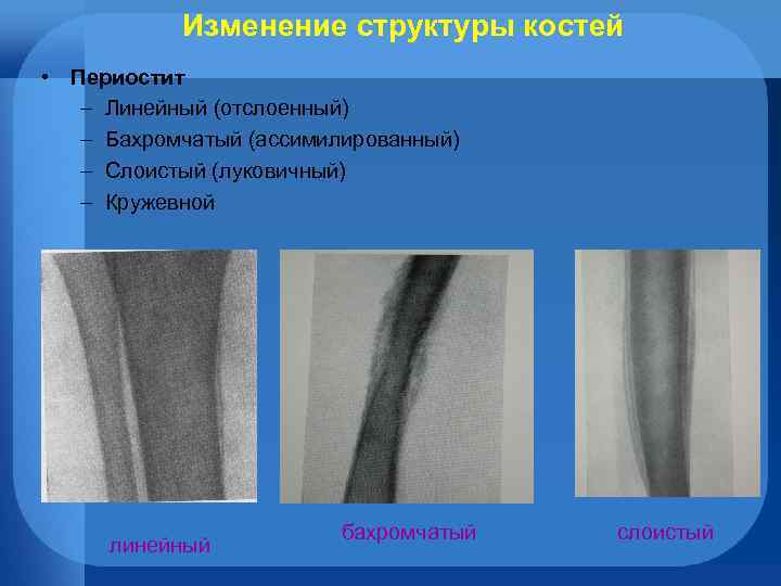 Изменение структуры костей • Периостит – Линейный (отслоенный) – Бахромчатый (ассимилированный) – Слоистый (луковичный)