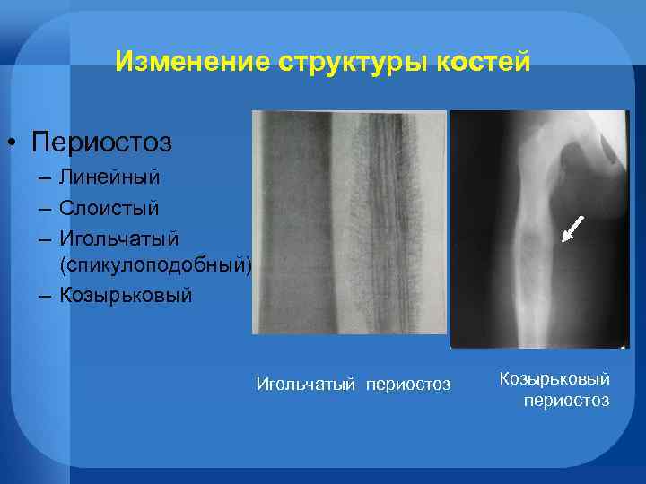 Изменение структуры костей • Периостоз – Линейный – Слоистый – Игольчатый (спикулоподобный) – Козырьковый