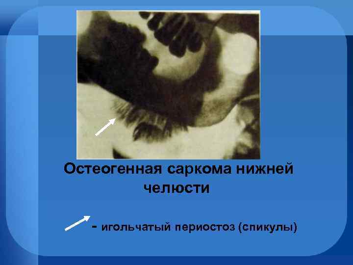 Остеогенная саркома нижней челюсти - игольчатый периостоз (спикулы) 