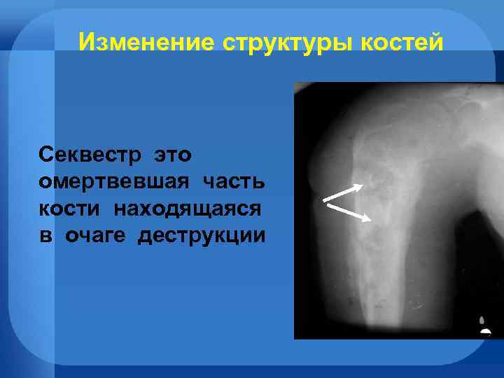 Изменение структуры костей Секвестр это омертвевшая часть кости находящаяся в очаге деструкции 