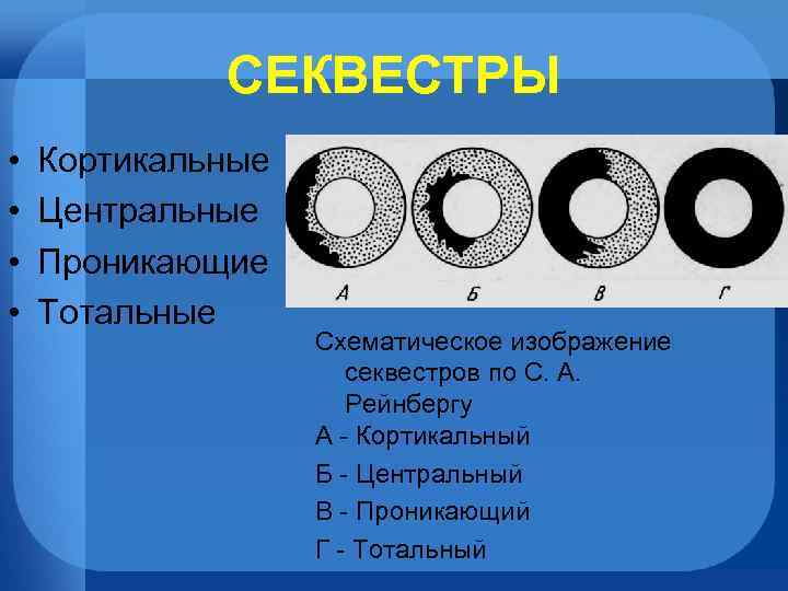 СЕКВЕСТРЫ • • Кортикальные Центральные Проникающие Тотальные Схематическое изображение секвестров по С. А. Рейнбергу