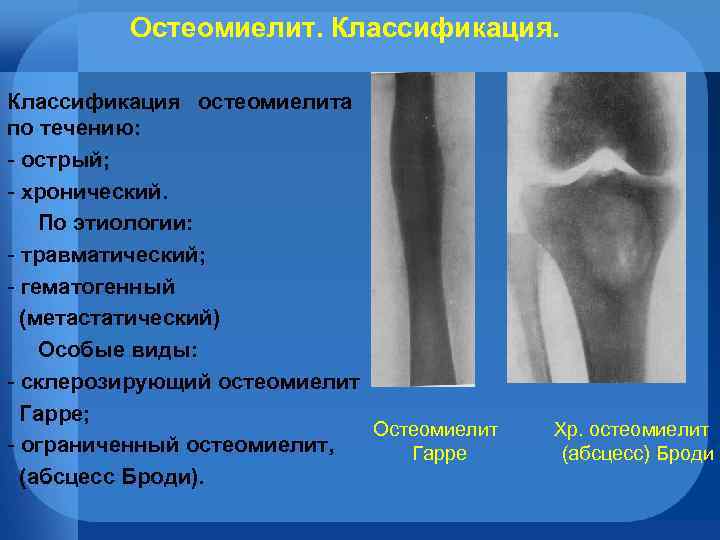 Остеомиелит. Классификация остеомиелита по течению: - острый; - хронический. По этиологии: - травматический; -