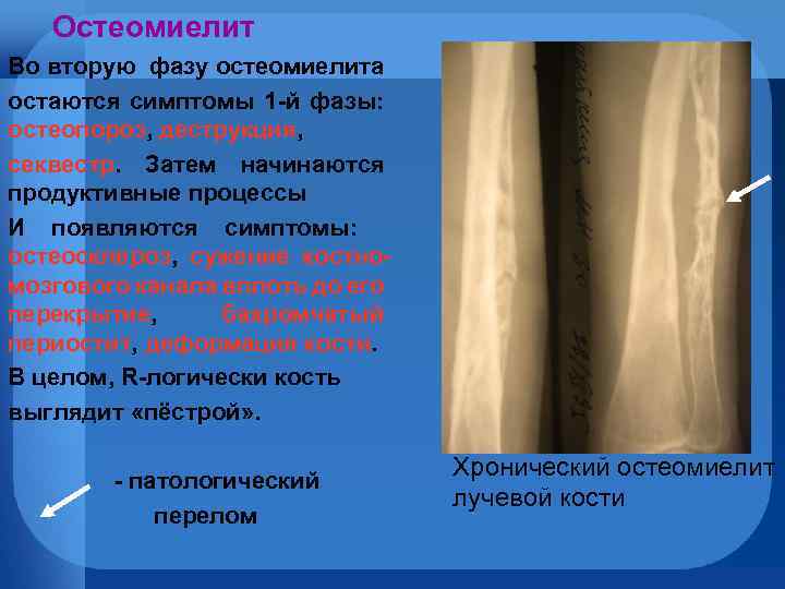 Остеомиелит Во вторую фазу остеомиелита остаются симптомы 1 -й фазы: остеопороз, деструкция, секвестр. Затем