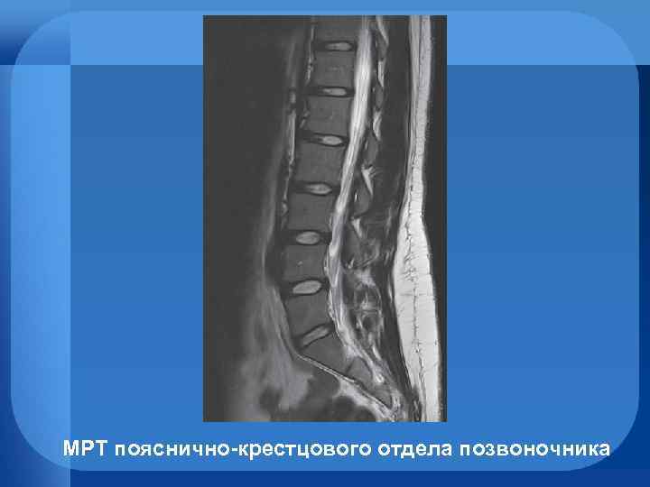 МРТ пояснично-крестцового отдела позвоночника 