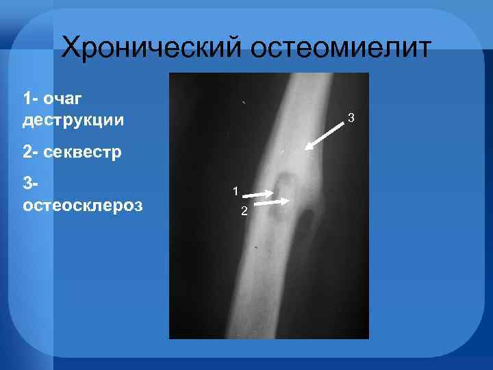 Рентгенодиагностика остеомиелита презентация