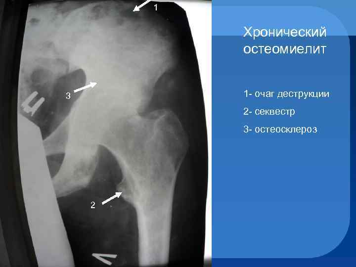 1 Хронический остеомиелит 1 - очаг деструкции 3 2 - секвестр 3 - остеосклероз