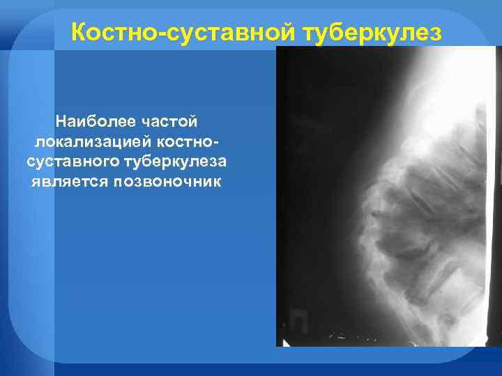 Костно-суставной туберкулез Наиболее частой локализацией костносуставного туберкулеза является позвоночник 