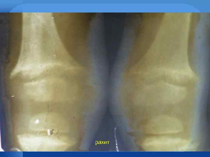 рахит 