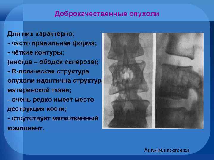 Доброкачественные опухоли Для них характерно: - часто правильная форма; - чёткие контуры; (иногда –