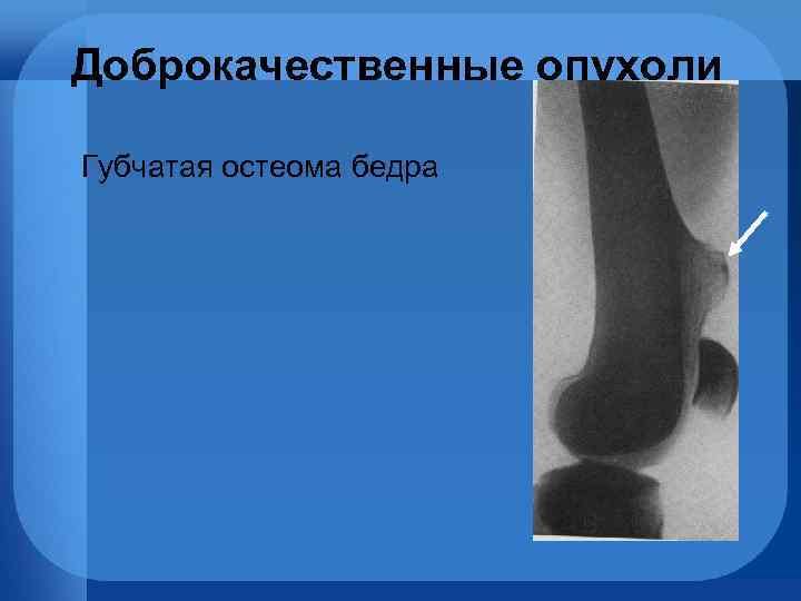 Доброкачественные опухоли Губчатая остеома бедра 