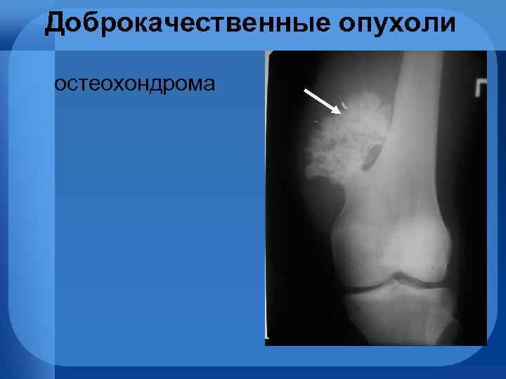 Доброкачественные опухоли остеохондрома 
