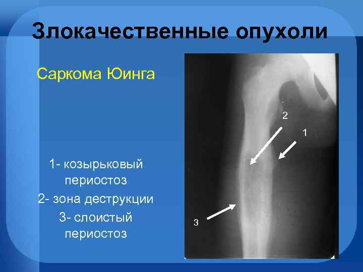 Злокачественные опухоли Саркома Юинга 2 1 1 - козырьковый периостоз 2 - зона деструкции