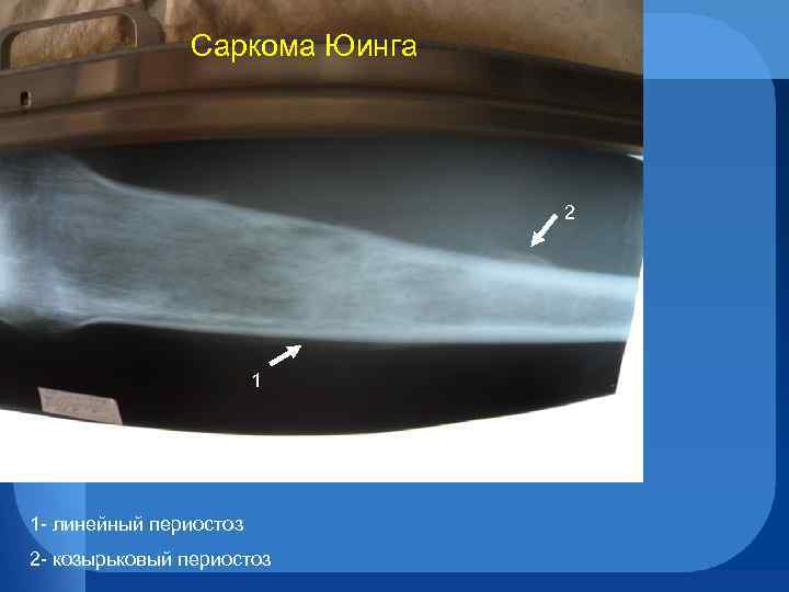 Саркома Юинга 2 1 1 - линейный периостоз 2 - козырьковый периостоз 
