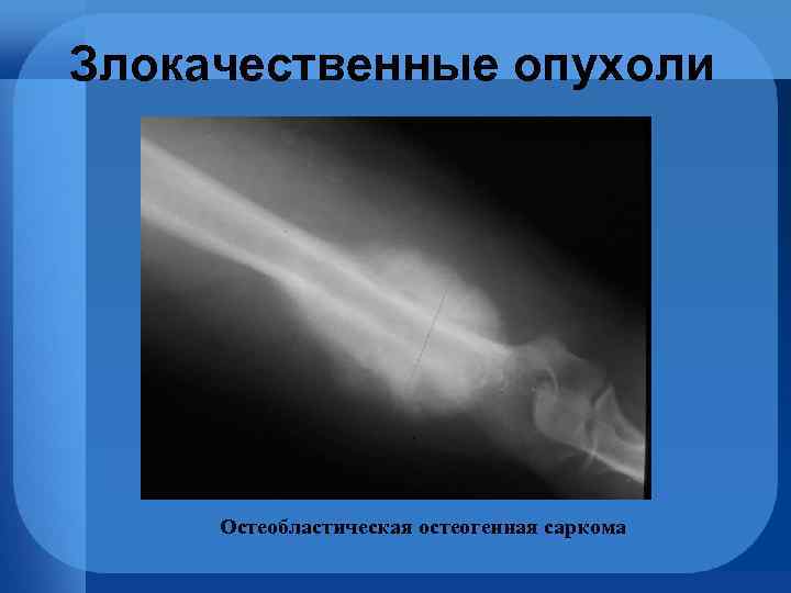 Злокачественные опухоли Остеобластическая остеогенная саркома 