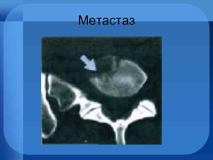 Метастаз 