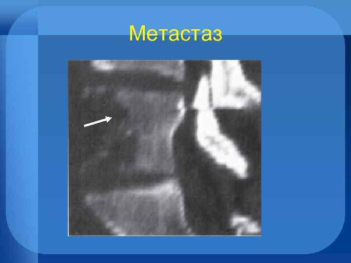 Метастаз 
