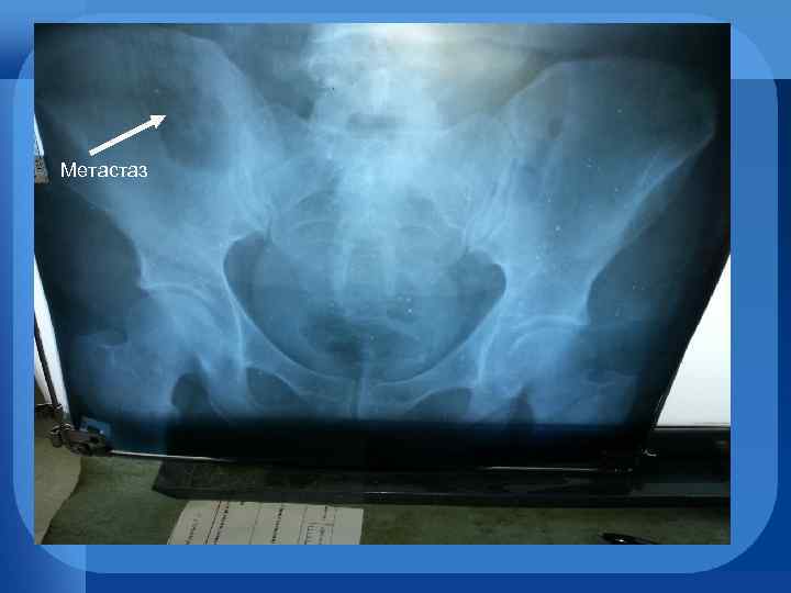 Метастаз 