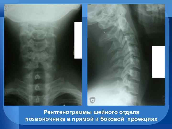 Рентгенограммы шейного отдела позвоночника в прямой и боковой проекциях 