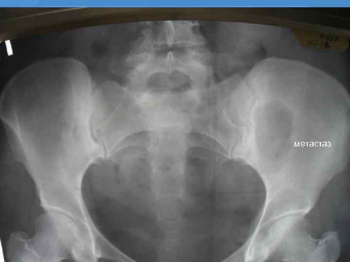 метастаз 