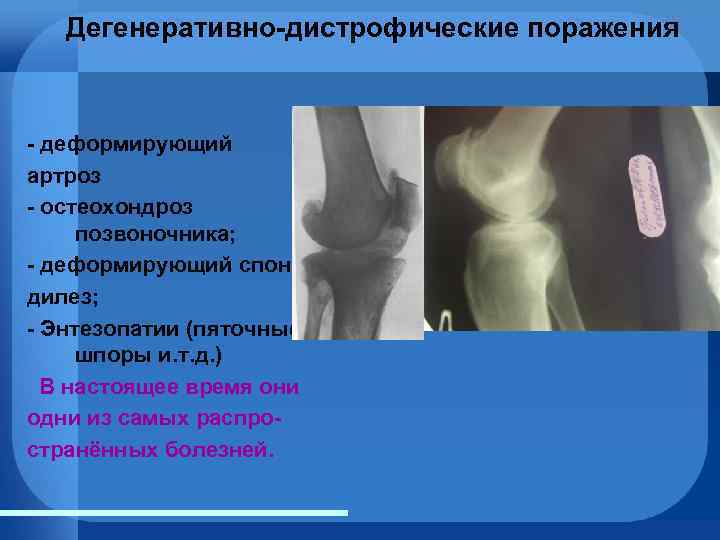 Рентгенологическая картина дегенеративно дистрофических поражений позвоночника