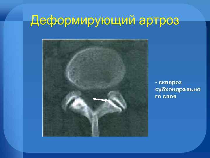 Деформирующий артроз - склероз субхондрально го слоя 