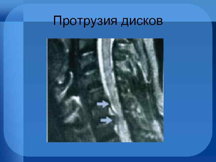 Протрузия дисков 