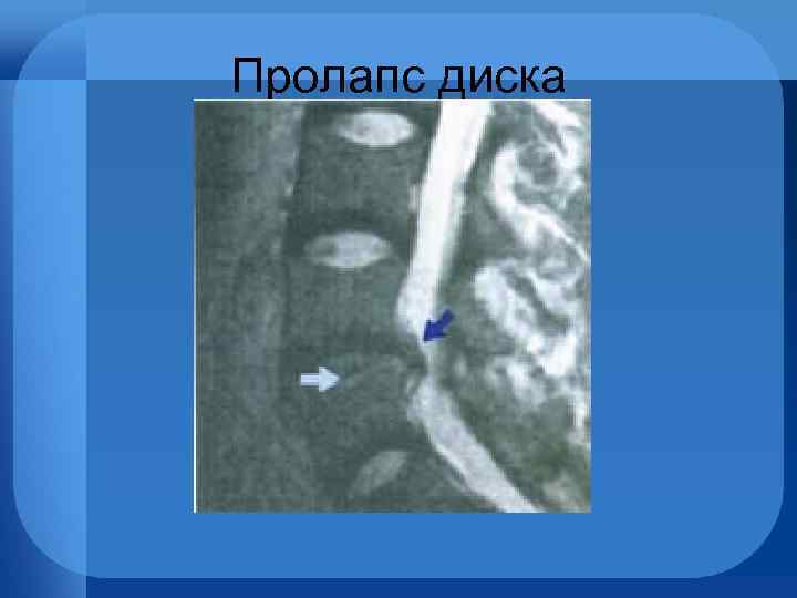 Пролапс диска 