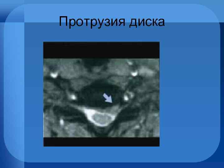 Протрузия диска 