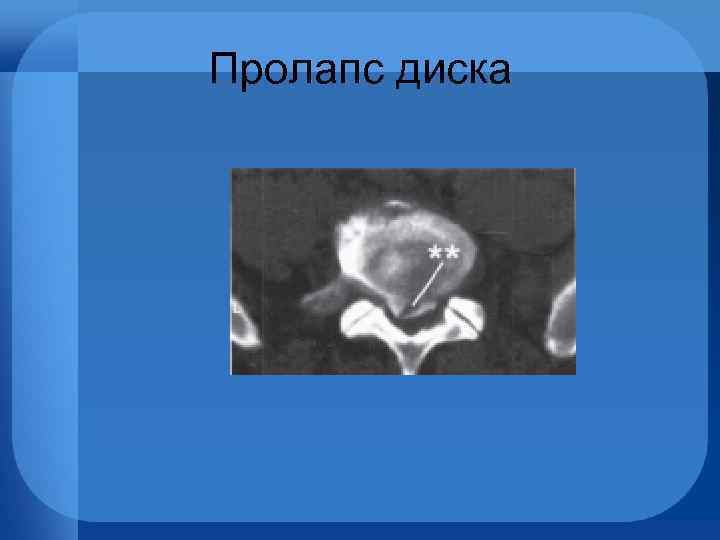 Пролапс диска 