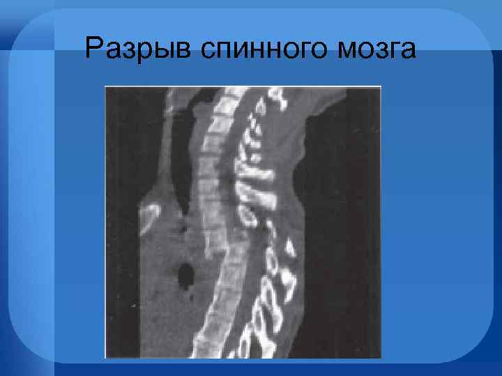 Разрыв спинного мозга 