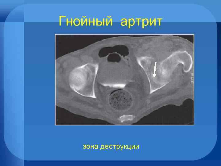 Гнойный артрит зона деструкции 
