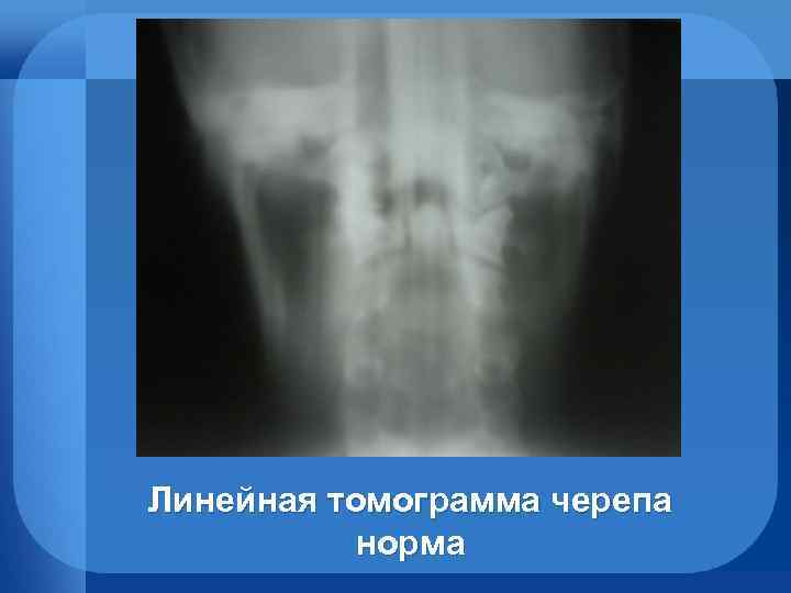 Линейная томограмма черепа норма 