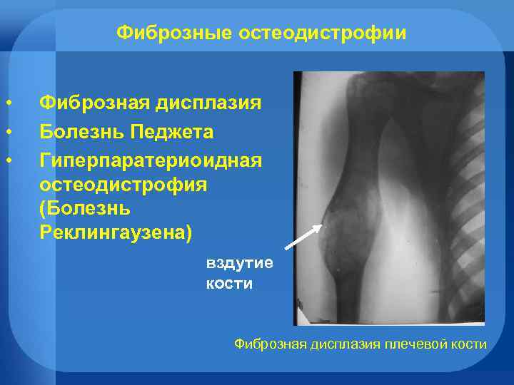 Фиброзные остеодистрофии • • • Фиброзная дисплазия Болезнь Педжета Гиперпаратериоидная остеодистрофия (Болезнь Реклингаузена) вздутие
